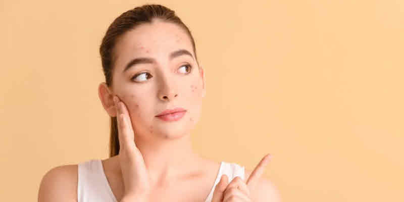 ¿Para qué sirve la Clindamicina en gel? Usos dermatológicos